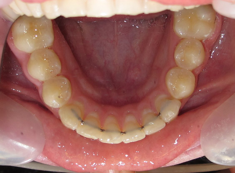 Fast retainer